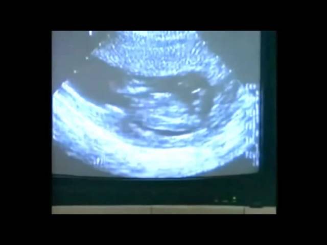 que siente el feto al ser abortado