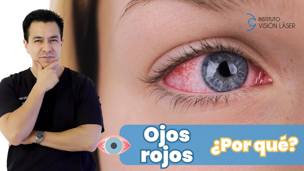porque se ponen los ojos rojos cuando tomas alcohol