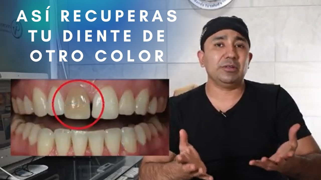se puede blanquear un diente muerto