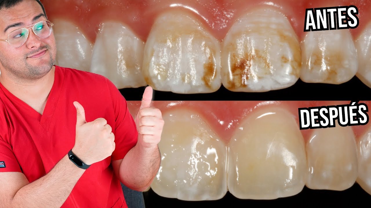 como quitar el fluor de los dientes